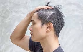 Niacin (vitamin b3) helps scalp circulation. Grey Hair In Teens Here S What You Can Do
