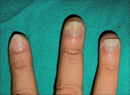 nail tic disorders manifestations