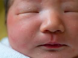 what causes milia in newborns babycenter