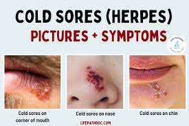 cold sores pictures of what they look