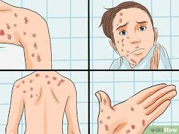 how to identify an hiv rash common