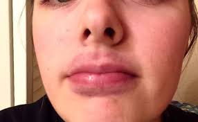 a bruised lip treat swollen lips