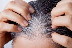 what causes white hair at early age and