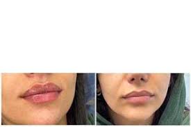 lip augmentation and lip lift in iran