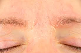 treatments for dry skin around eyes