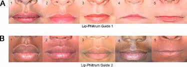 vermilion upper lip thick
