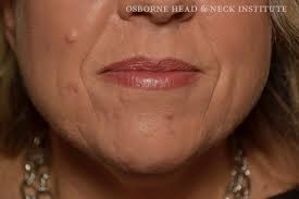 lip chin cancer surgery skin cancer