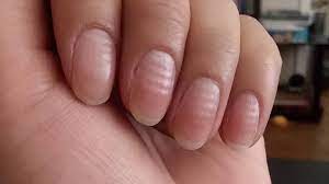 ridges appear on your nails