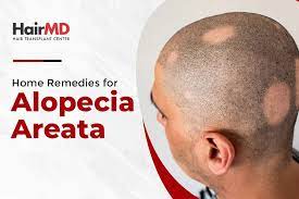 home remes for alopecia areata