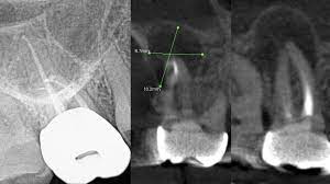 why cone beam ct scan cbct is a must