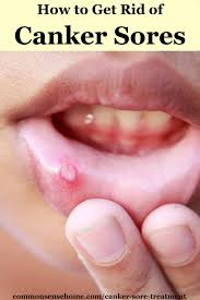 canker sore treatment how to get rid