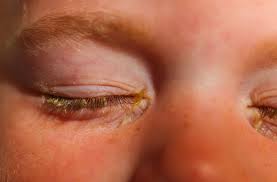 pink eye vs allergy symptoms total