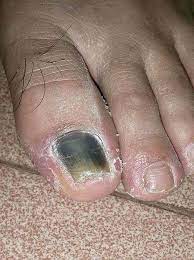 what is black toenail and how to treat