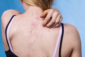itchy acne types causes treatments