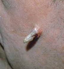 actinic keratosis richmond dermatology
