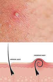 folliculitis is laser hair removal