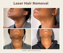 laser hair removal morristown nj