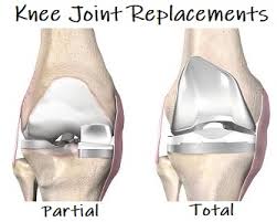 knee joint replacement surgery