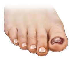 toenail falling off causes