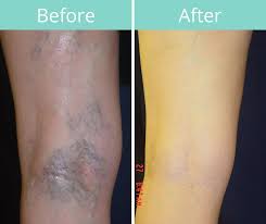 So, will insurance cover vein treatment for everyone? Can Spider Veins Turn Into Varicose Veins East Tennessee Vein Clinic
