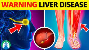 early warning signs of liver disease