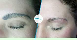 eyebrow tattoo removal clinique du lac