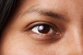 what causes dark eye circles eeva