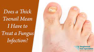 fix dry fungal toenails keryflex nail