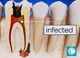 root cs endodontics for teeth