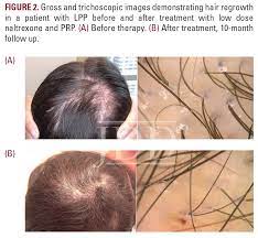 reversible hair loss in lichen