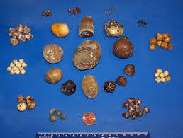 Gallstones From A Pathological View