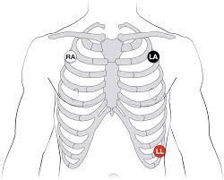 Ecg Lead Positioning Litfl Medical Blog Ecg Library Basics