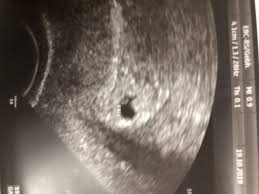 Der embryo ist auf dem ultraschall zu dieser zeit oft noch nicht zu erkennen. 7 Ssw Ultraschall Schwangerschaftsgruppe Babycenter