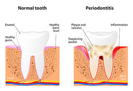 advanced periodontal treatments
