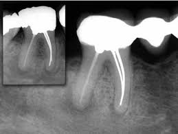 apical periodonis may continue for