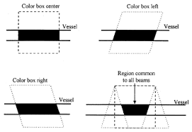 cross beam vector doppler ultrasound