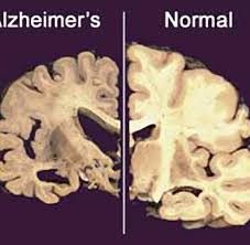 Alzheimer's disease is an irreversible, progressive brain disorder that slowly destroys memory and thinking skills and, eventually, the ability to carry out the simplest tasks. Medizin Aluminium Lost Womoglich Alzheimer Aus Welt