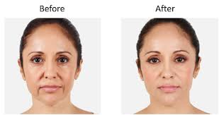 the liquid facelift boost your look