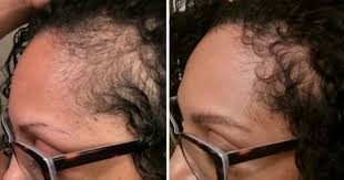 How can a fungal infection cause hair loss? Here S How You Can Cure Your Scalp Infection Naturallycurly Com