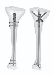 orthopedic instrument anium tibia