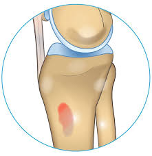 knee pain on inside of joint 5 reasons why