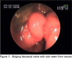 endoscopic removal of a coin impacted