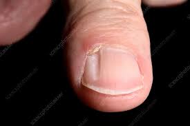 grooved nail with mucous cyst stock