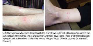 The picture below shows and highlights these lines. Bed Bug Supplement How Bed Bug Bite Reactions Differ Pct Pest Control Technology