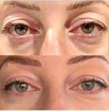 non surgical blepharoplasty eyelid