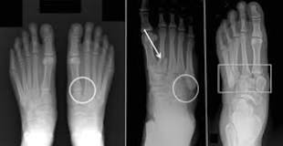 Image result for icd 10 code for right lisfranc fracture