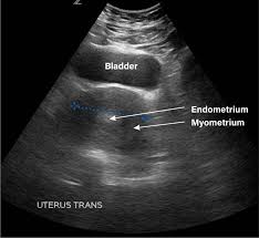 Your exam will take approximately 45 minutes. Gynecology Pelvic Ultrasound Made Easy Step By Step Guide Pocus 101