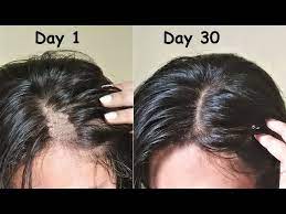 castor oil to regrow new hair in 30