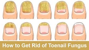 how to get rid of toenail fungus fast