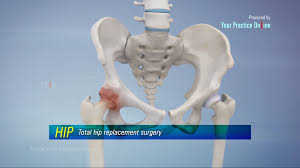 total hip replacement surgery video